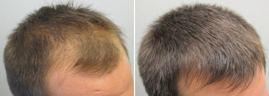 Миноксидил для роста волос ‒ роскошная шевелюра, борода уже после одного месяца применения