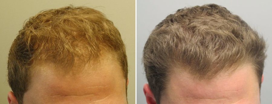 Миноксидил для роста волос ‒ роскошная шевелюра, борода уже после одного месяца применения